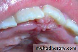 benign tumor and tumor like lesion