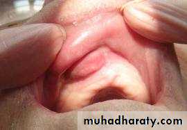 benign tumor and tumor like lesion