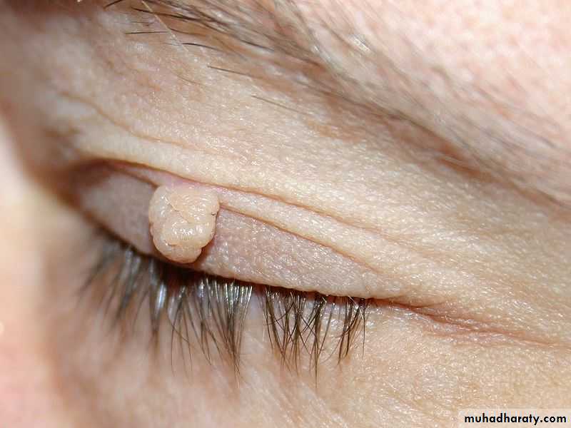 benign tumor and tumor like lesion