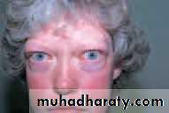 THYROID EYE