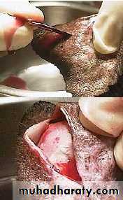 تكملة haematoma و abscess و cyst