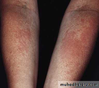 light related disorder