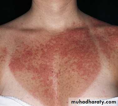 light related disorder