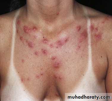 light related disorder