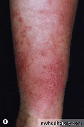 light related disorder
