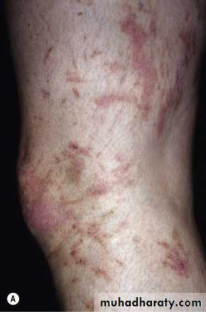 light related disorder