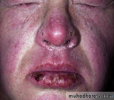 light related disorder