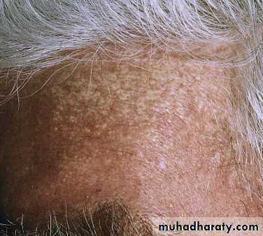 light related disorder