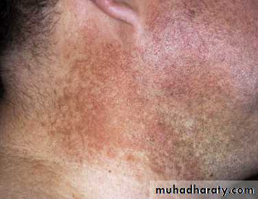 light related disorder