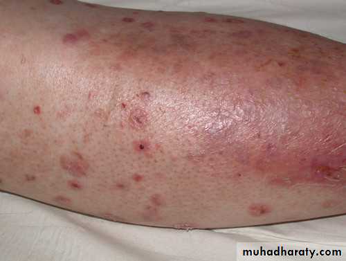Cutaneous manifestation of systemic disease