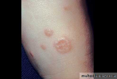 Cutaneous manifestation of systemic disease