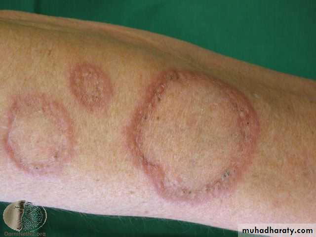 Cutaneous manifestation of systemic disease