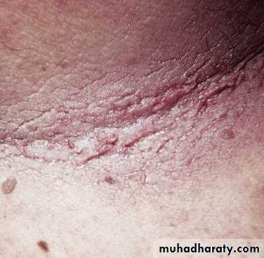 Cutaneous manifestation of systemic disease