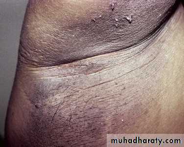 Cutaneous manifestation of systemic disease