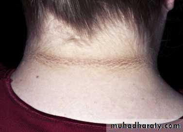 Cutaneous manifestation of systemic disease