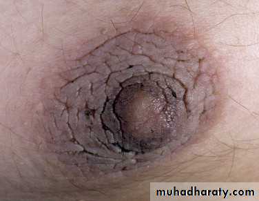 Cutaneous manifestation of systemic disease