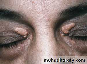 Cutaneous manifestation of systemic disease
