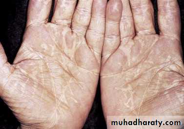 Cutaneous manifestation of systemic disease