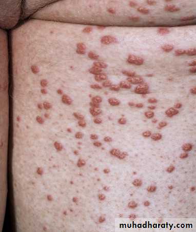 Cutaneous manifestation of systemic disease