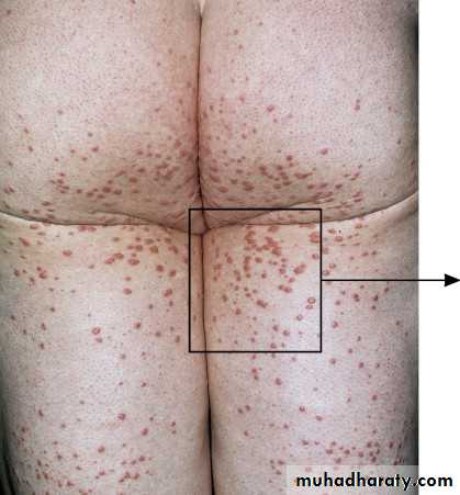 Cutaneous manifestation of systemic disease