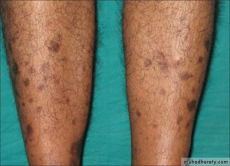 Cutaneous manifestation of systemic disease