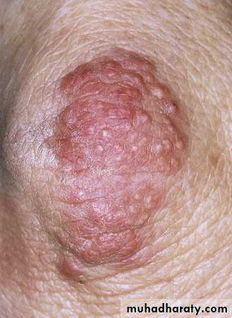 Cutaneous manifestation of systemic disease