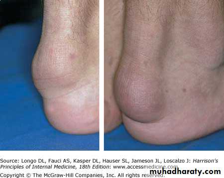 Cutaneous manifestation of systemic disease