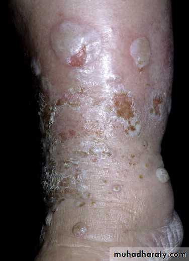 Cutaneous manifestation of systemic disease