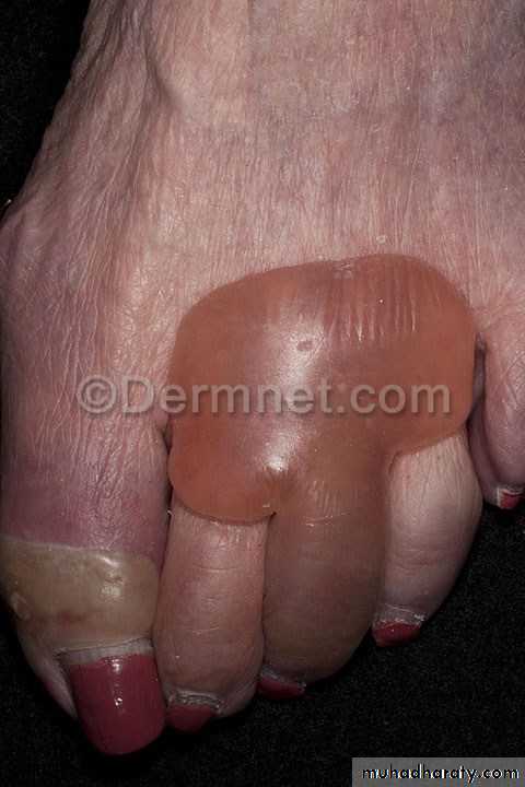 Cutaneous manifestation of systemic disease