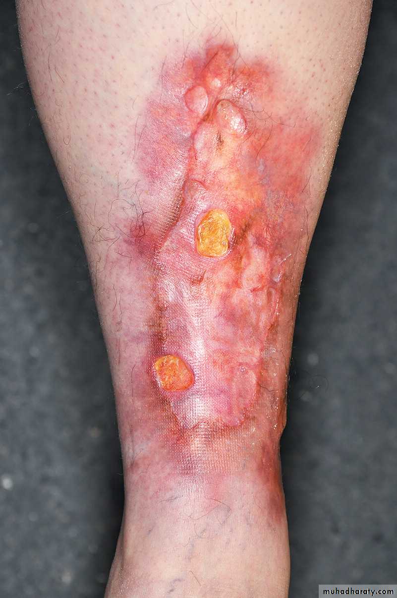 Cutaneous manifestation of systemic disease