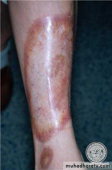 Cutaneous manifestation of systemic disease
