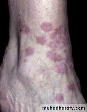 Cutaneous manifestation of systemic disease