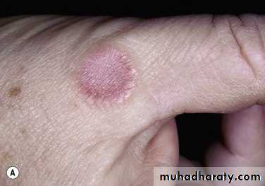 Cutaneous manifestation of systemic disease