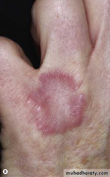 Cutaneous manifestation of systemic disease