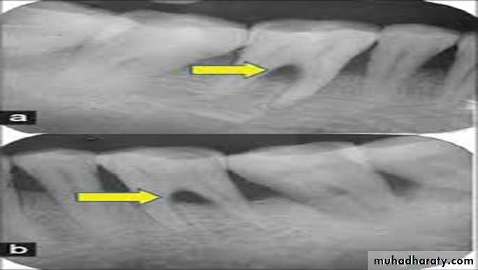 furcation involvement
