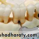 furcation involvement