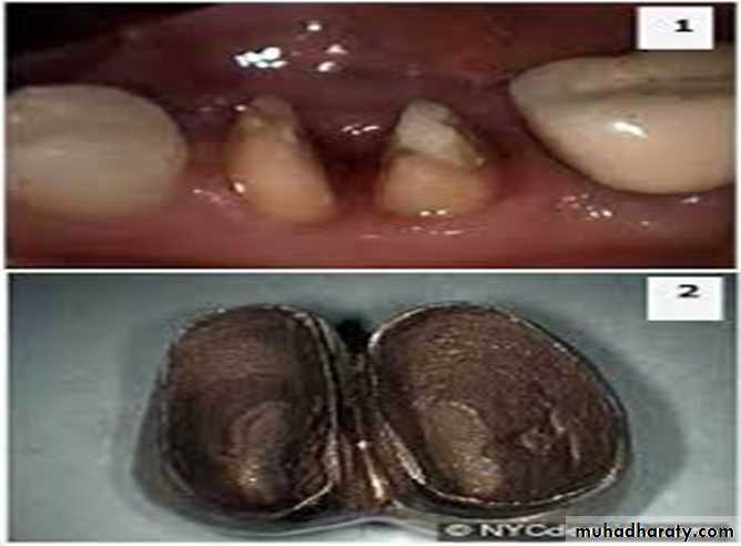 furcation involvement