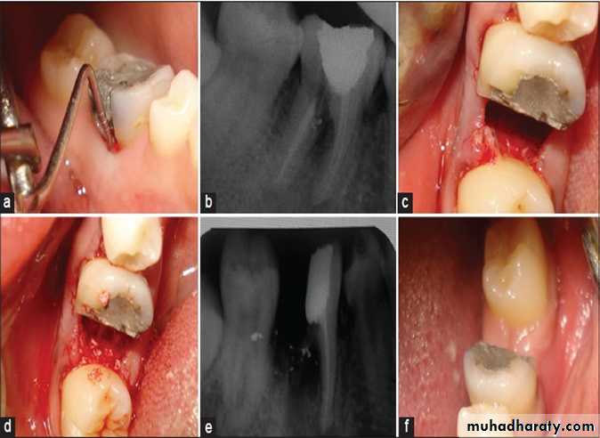 furcation involvement