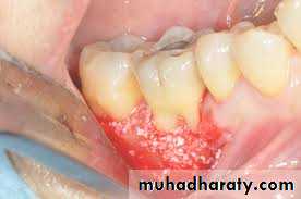 furcation involvement
