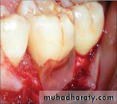 furcation involvement