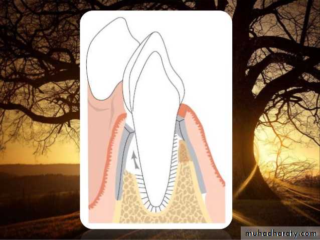 furcation involvement