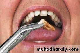 furcation involvement
