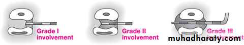 furcation involvement