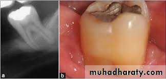 furcation involvement