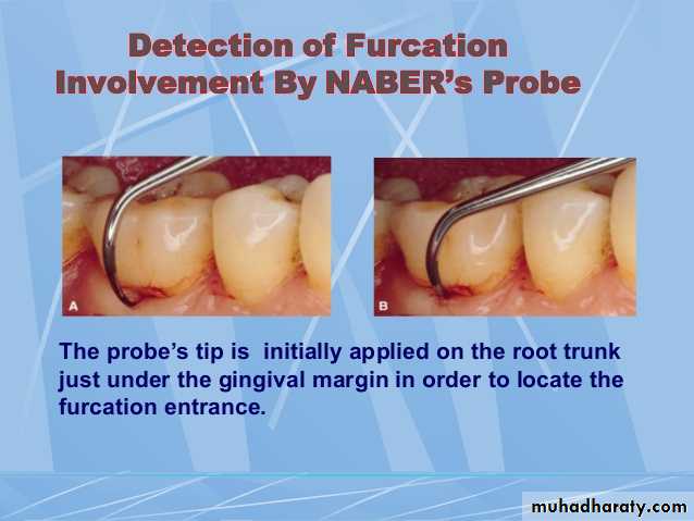 furcation involvement