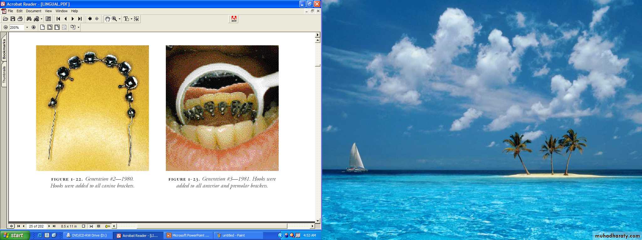 lingual orthodontic