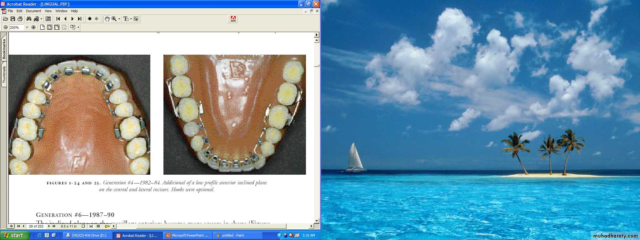 lingual orthodontic
