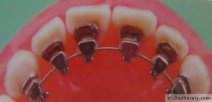 lingual orthodontic