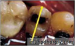 lingual orthodontic