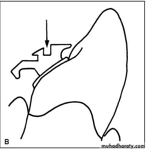 lingual orthodontic